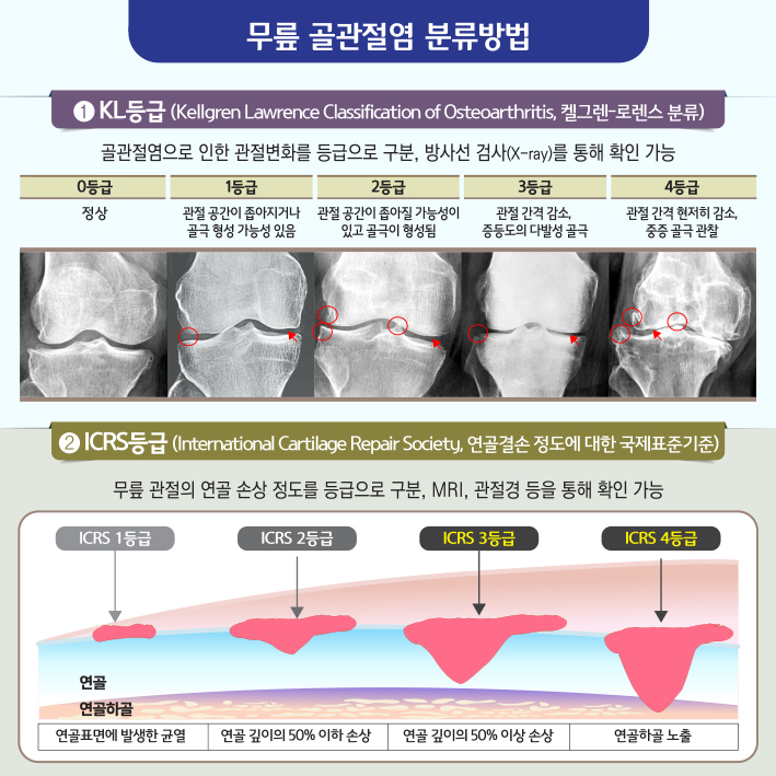 무릎 골관절염에 대한 골수 흡인 농축물 관절강내 주사(BMAC) 이미지4