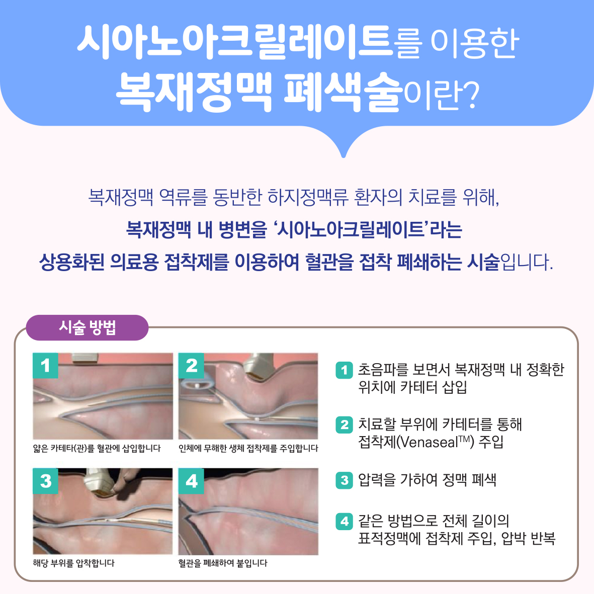 시아노아크릴레이트를 이용한 복재정맥 폐색술 이미지4
